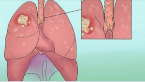 Kahdeksan epätyypillistä keuhkosyövän oiretta, joita et voi jättää huomiotta!
