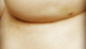 Viaton kuva rinnasta paljastaa vähemmän tunnetun syövän oireen. Huomaatko sen?